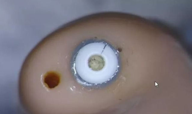 助聽器出聲孔堵塞